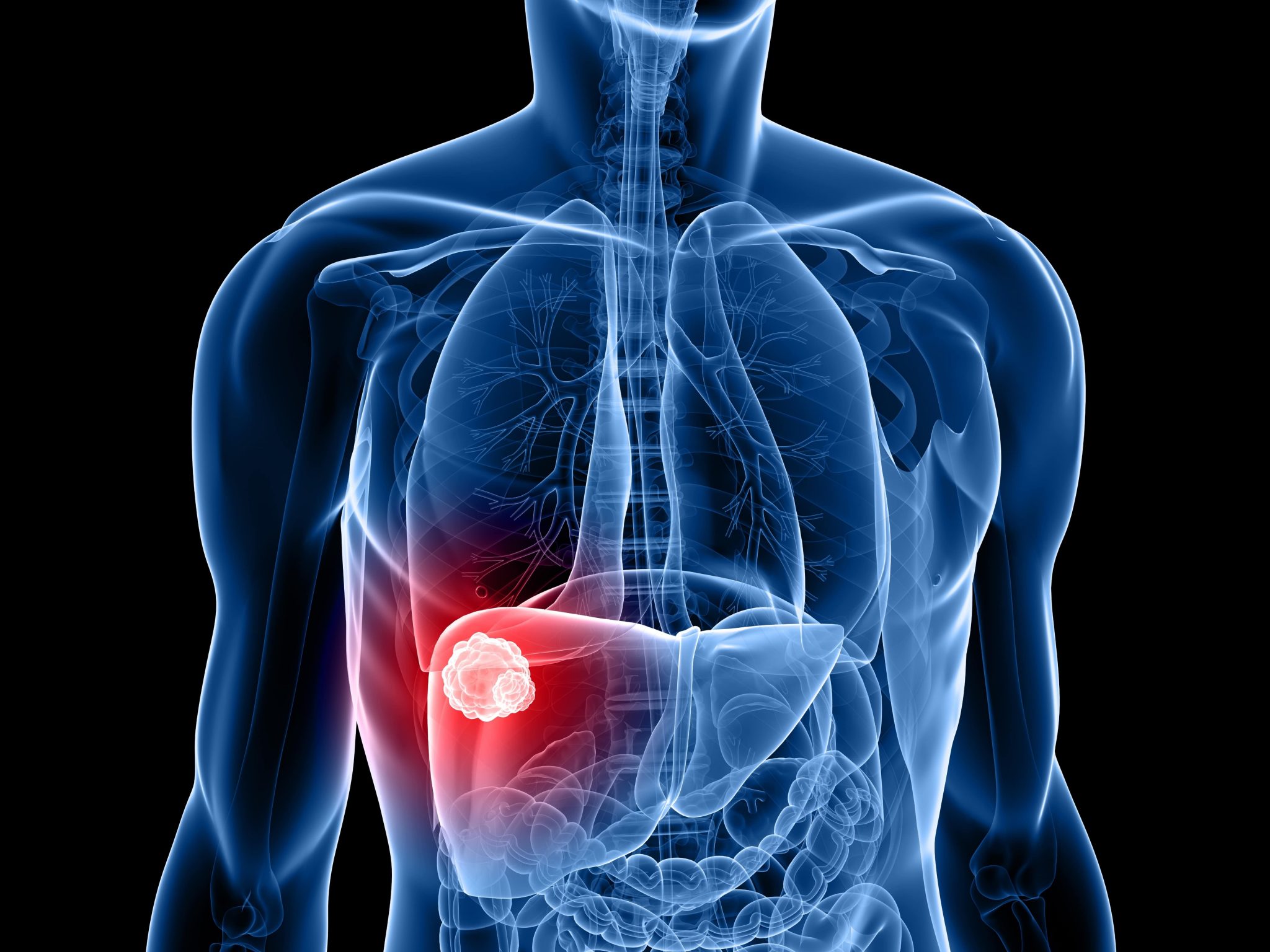 What are the last stages of liver cancer before death?